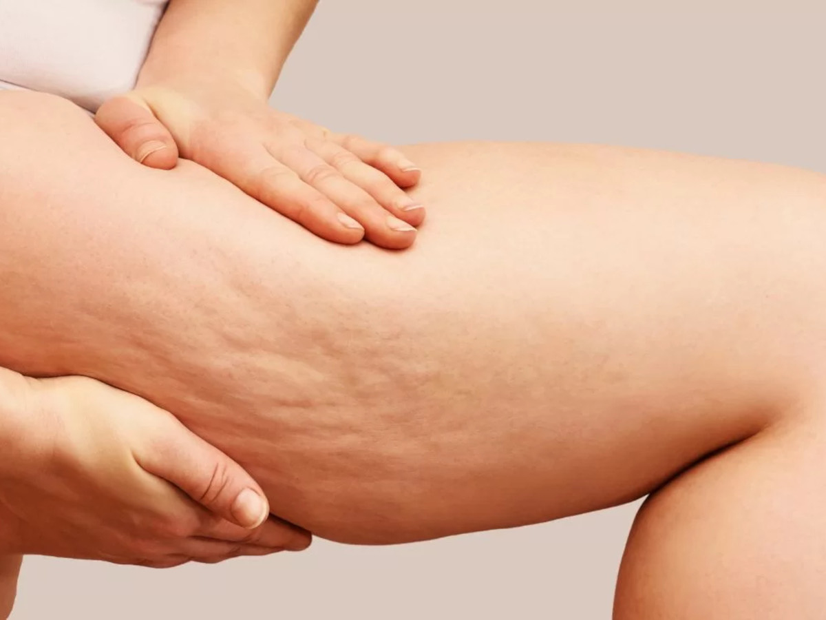 Lipedema: una malattia genetica ed ereditaria?